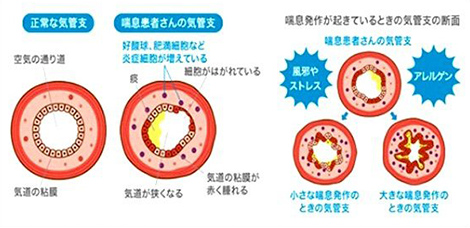 成人の気管支喘息